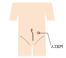 人工肛門