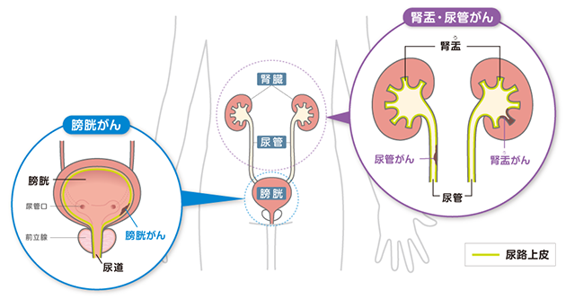 尿路上皮がんとは